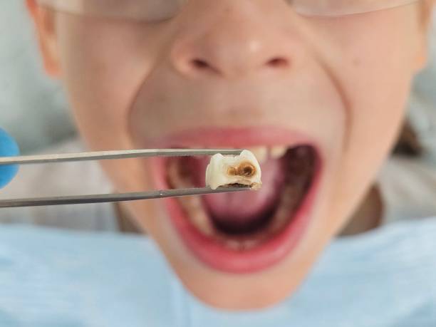 Best Emergency Treatment for Dental Infections or Abscesses in Carney, MD